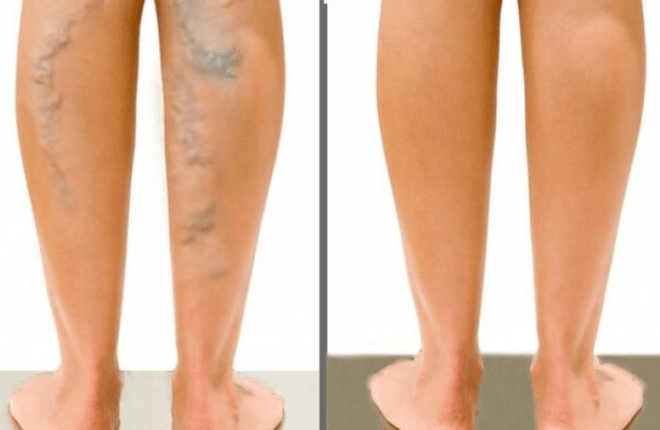 Varicose veins before and after surgery