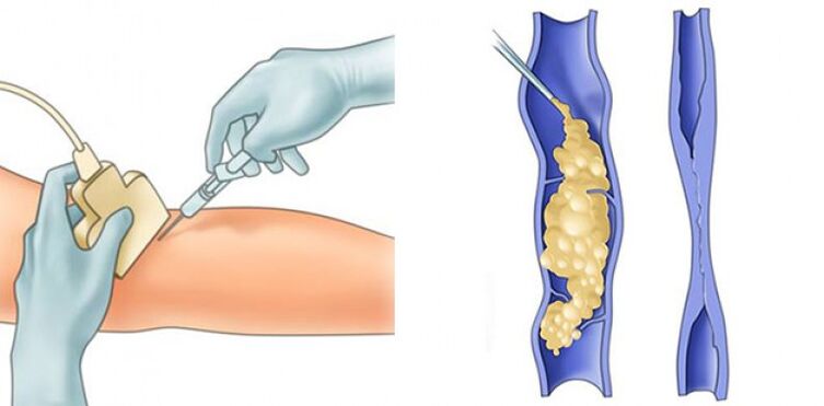 Treatment of varicose veins