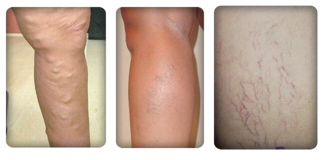 Stages of varicose veins