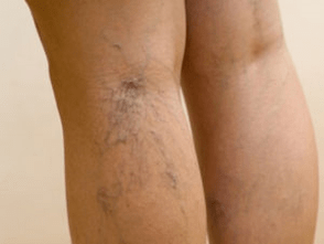 The second stage of varicose veins