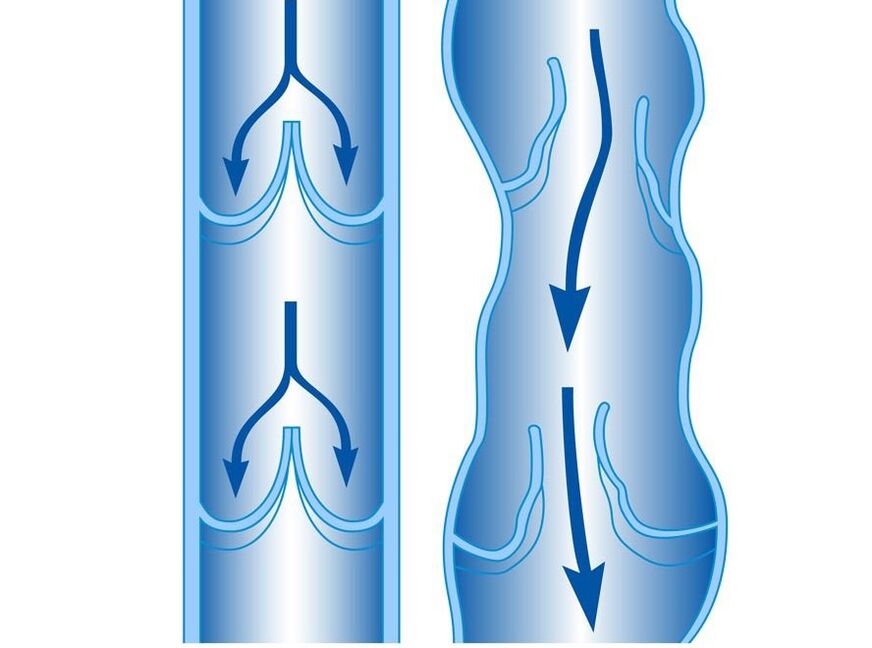 healthy and varicose vein