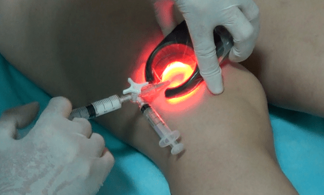 Sclerotherapy is an effective method of treating varicose veins on the legs