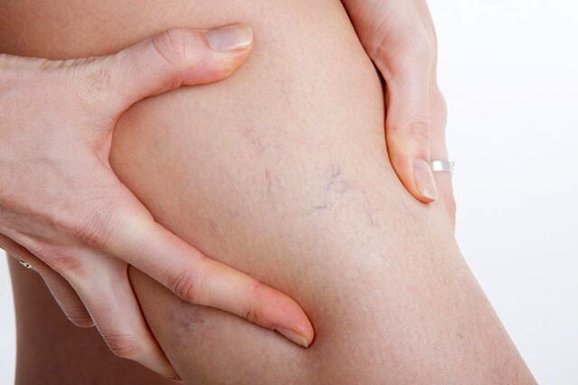 The first appearances of varicose veins on the leg