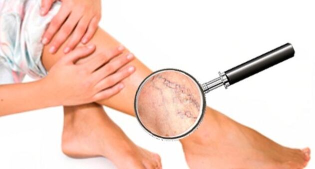 Varicose veins on the legs